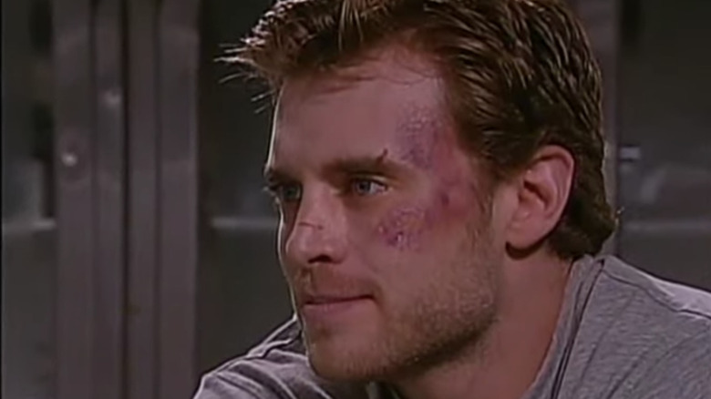 Richie Novak with bruise on cheek